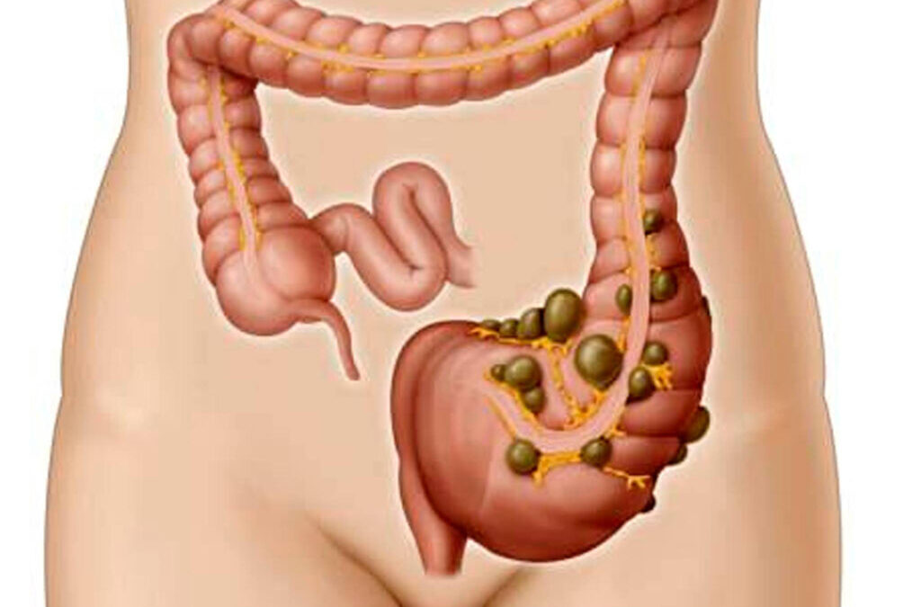 Diverticulosis una enfermedad nada divertida