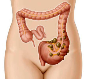 Diverticulosis