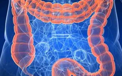 Placa mucoide en el intestino