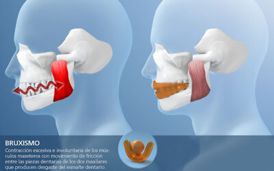 Mandibula de Hierro: BRUXISMO