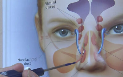 Migraña Cuando la cabeza no da mas