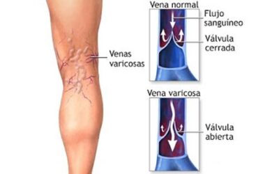 Varices Algunos remedios