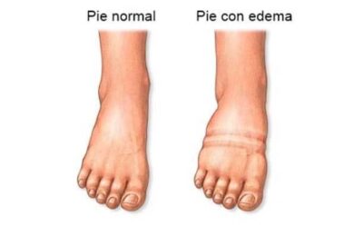 RETENCIÓN DE LÍQUIDOS