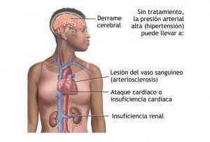 Hipertensión arterial 12 indispensables