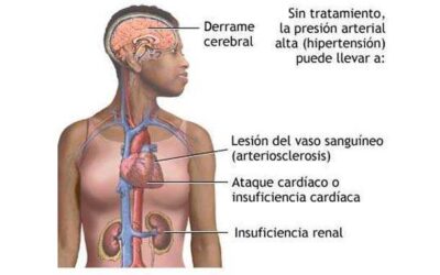 Hipertensión arterial 12 indispensables