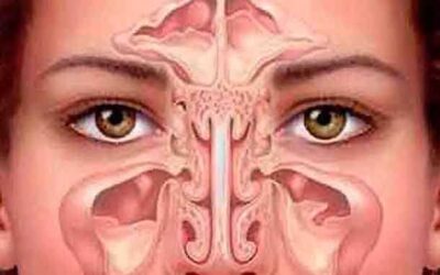 Emplaste para limpiar la Sinusitis