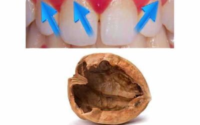 2 RECETAS PARA ELIMINAR LA PLACA DENTAL