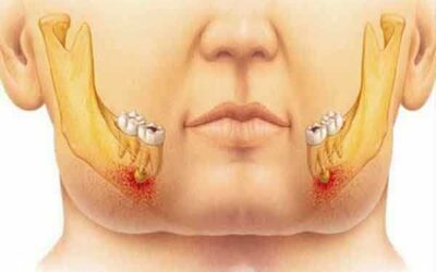 CONSEJOS PARA EVITAR DIENTES DETERIORADOS