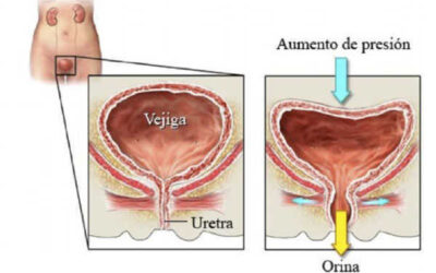 Como tratar la incontinencia urinaria