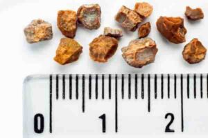 Piedras en el riñón