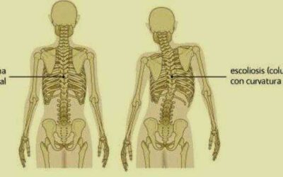 ESCOLIOSIS: Tratamiento Natural