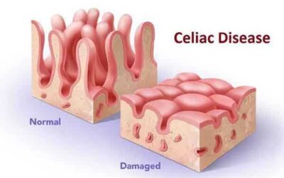 La sensibilidad al gluten