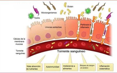 SINTOMAS DE PERFORACIÓN INTESTINAL