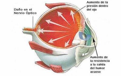GLAUCOMA: SÍNTOMAS ENTENDIDOS METAFORICAMENTE