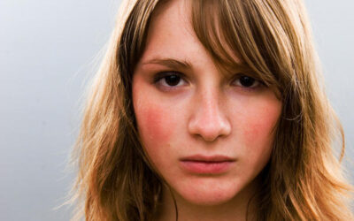 Rubor Facial Excesivo