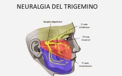 NEURALGIA DEL TRIGEMINO