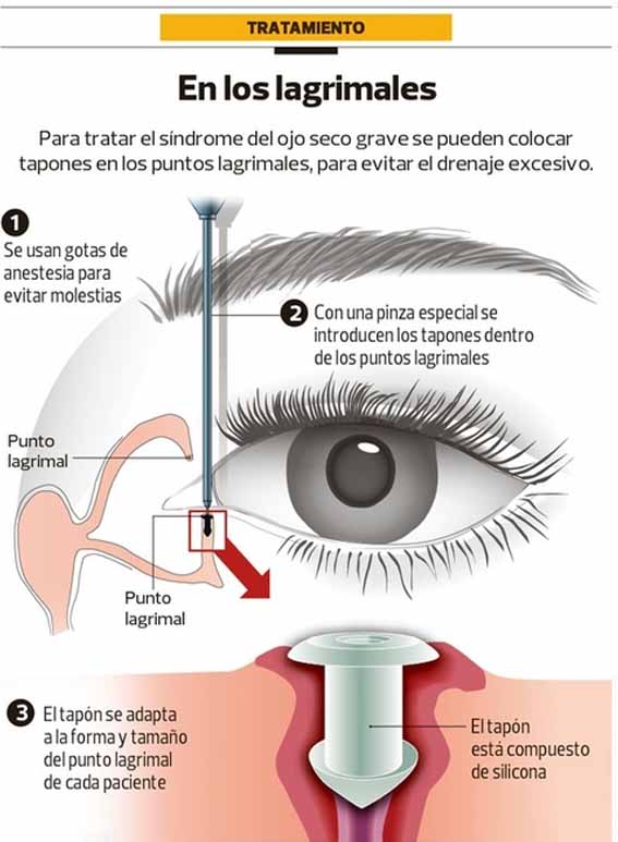 SÍNDROME DEL OJO SECO SÍNDROME DEL OJO SECO