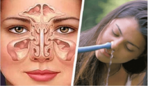 sinusitis