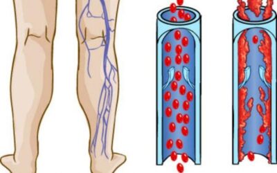 CONSEJOS PARA TRATAR LAS VARICES