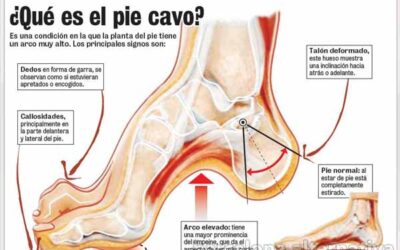 CONSEJOS PARA EL PIE CAVO