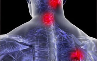 Cómo aliviar las contracturas cervicales de forma natural