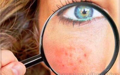 PORQUE APARECE LA ROSACEA Y COMO PREVENIRLA