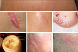 FORMULA PARA ELIMINAR CICATRICES EN MENOS DE UN MES