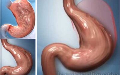 REDUCE TU ESTOMAGO SIN CIRUGIA