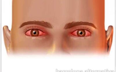 Conjuntivitis: Lo mas típico de la piscina