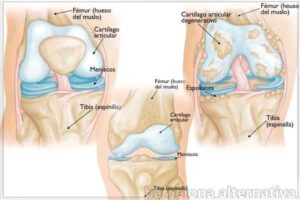 Osteoartritis de rodilla