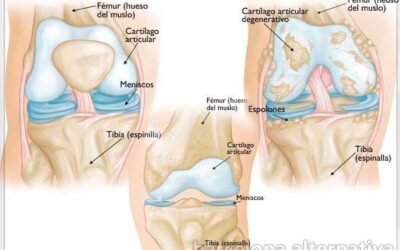 Osteoartritis de rodilla