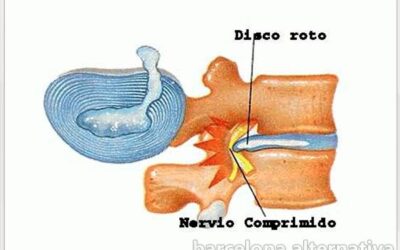 HERNIA DISCAL Y EMOCIONES RELACIONADAS