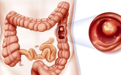 Pólipos en el colon: biodescodificación